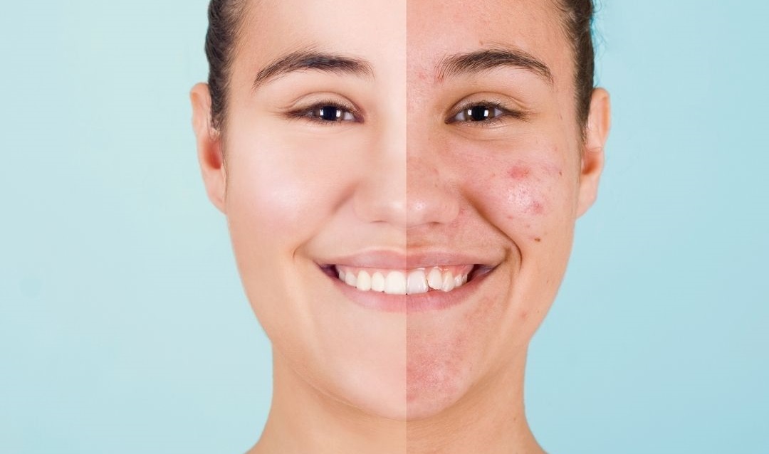 Acne treatment in Beeramguda