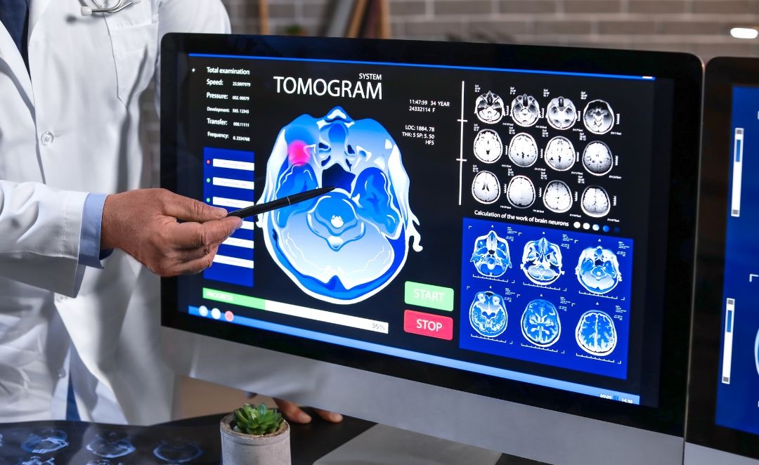 Best Neurologist in Beeramguda