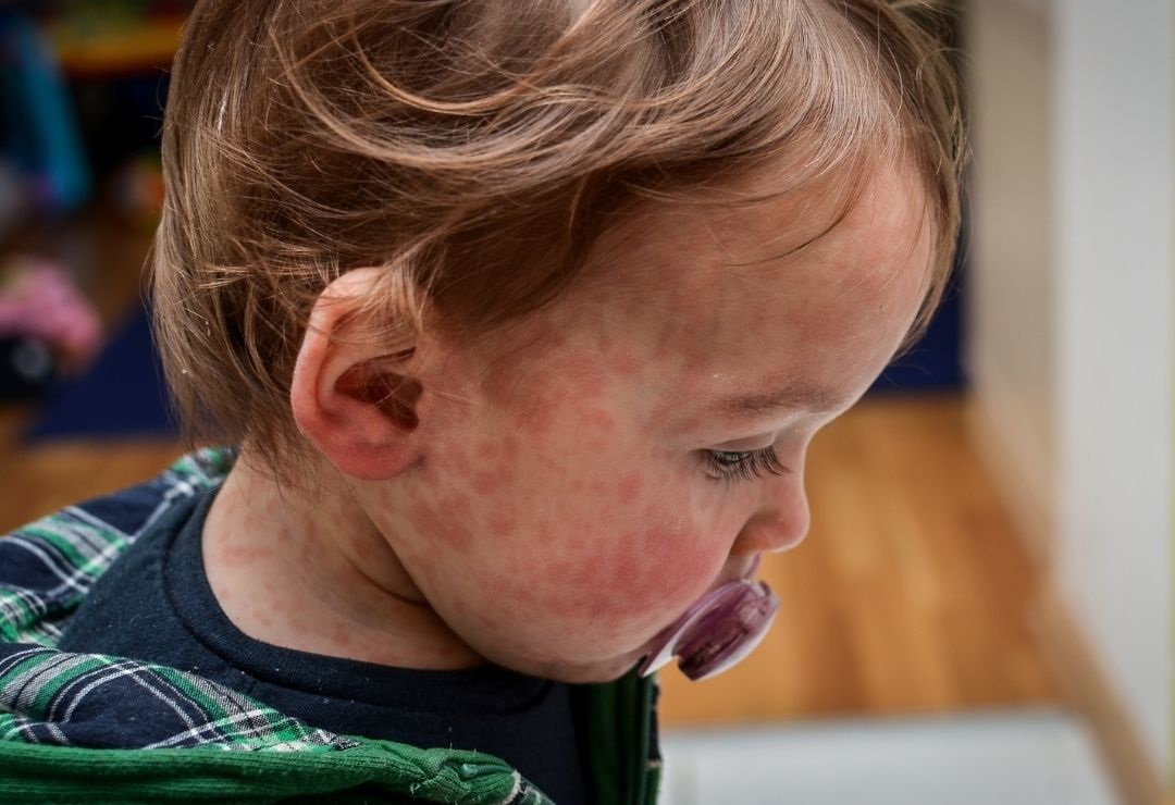 children skin specialist in beeramguda