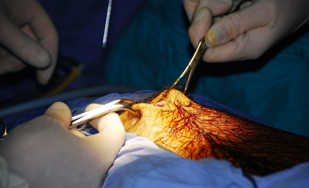 Minimal Access Surgery/Keyhole Surgery