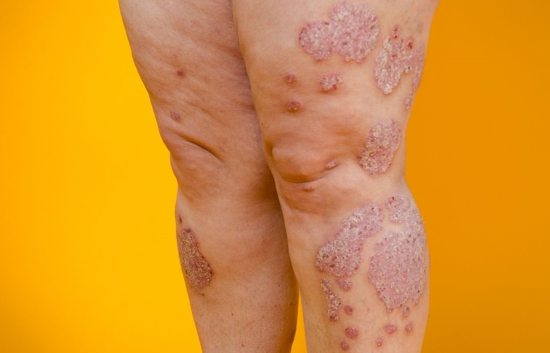 Psoriasis treatment in Beeramguda 